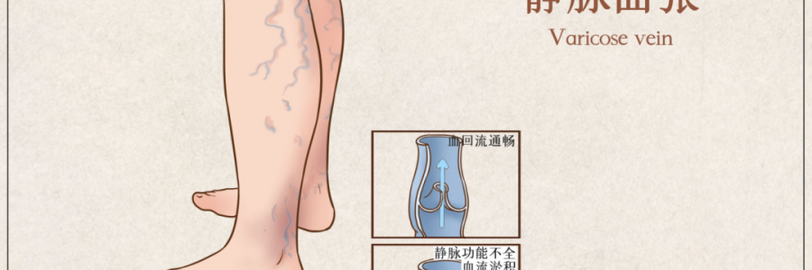 告別“蚯蚓腿”，靜脈曲張?jiān)趺凑{(diào)？