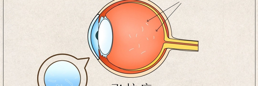 “蚊子”在眼里飛？這類人要注意了！